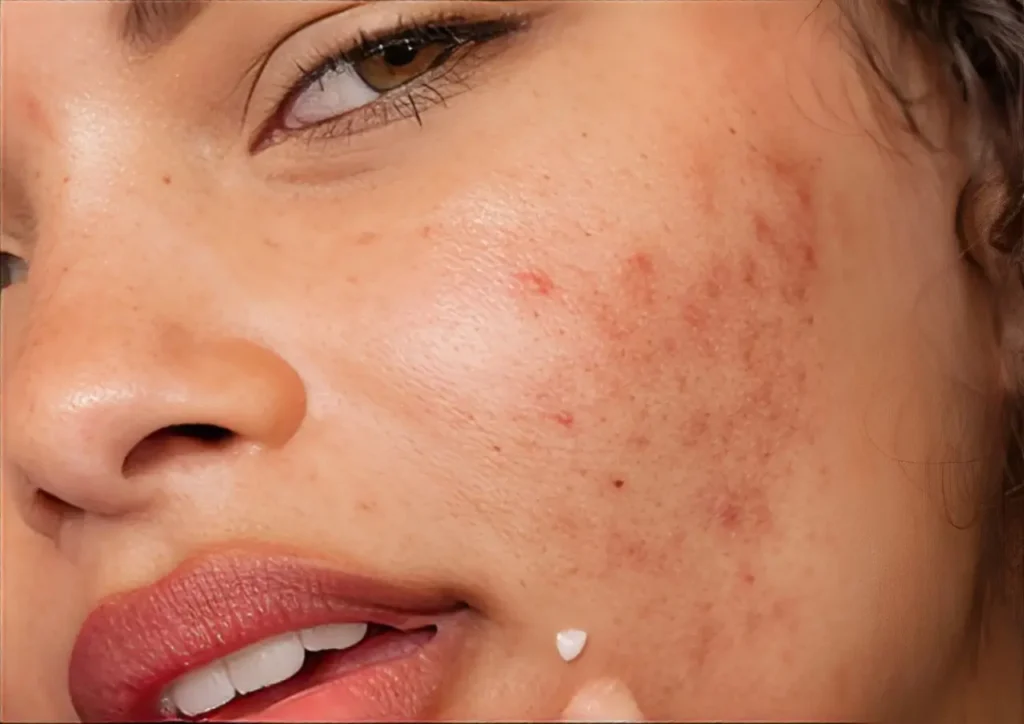 how-to-use-nizoral-for-acne-heres-the-secret