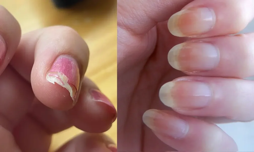 How to prevent nail breakage